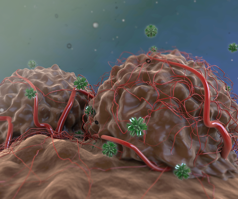 glioblastoma tumor illustration